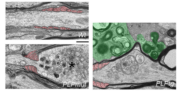 Effective removal of abnormal myelin allows survival of nerve fibers targeted by adaptive immune cells