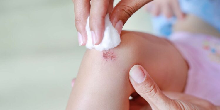 Beware of serious immediate allergic reactions to this ingredient in antiseptics and hygiene products