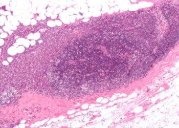 Improving the prediction of advanced breast cancer in women of different races and ethnicities