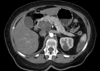 New form of immunotherapy being studied for cancer that is resistant to conventional T-cell therapies