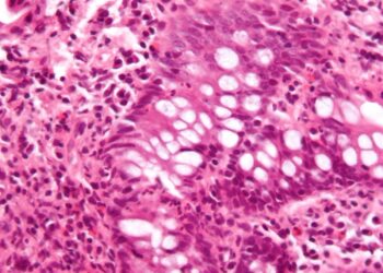 New method discovers biomarker for inflammatory bowel disease