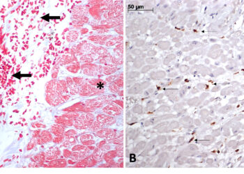 Researchers report detailed analysis of heart damage caused by yellow fever virus