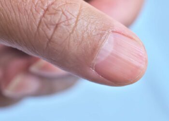 This strange disease causes fingernails and toenails to disappear!