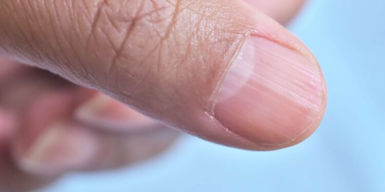 This strange disease causes fingernails and toenails to disappear!