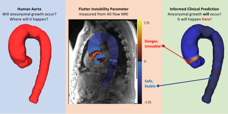 Unstable “float” predicts aortic aneurysm with 98% accuracy