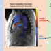 Unstable “float” predicts aortic aneurysm with 98% accuracy