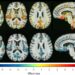 Brain structure predicts treatment response to antidepressants and placebos, study finds
