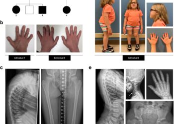 Discovery reveals mystery of rare bone disease