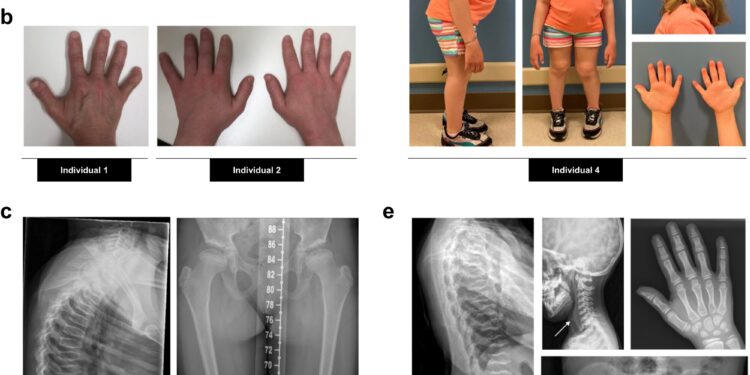 Discovery reveals mystery of rare bone disease
