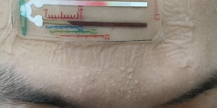 Dual-channel sensor measures biomarker concentration in sweat