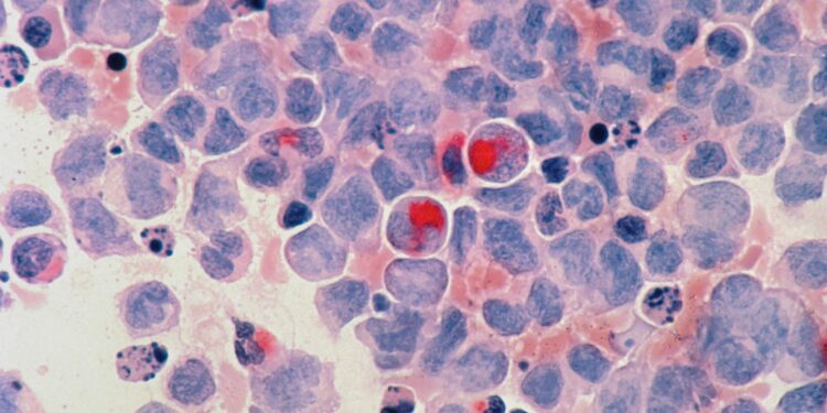 Investigators profile three treatment response trajectories to approach triple negative breast cancer