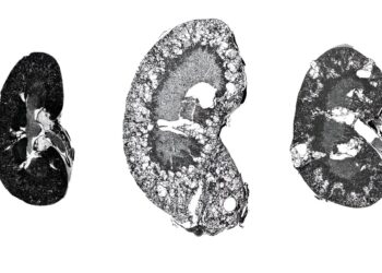 New drug candidate may shrink kidney cysts