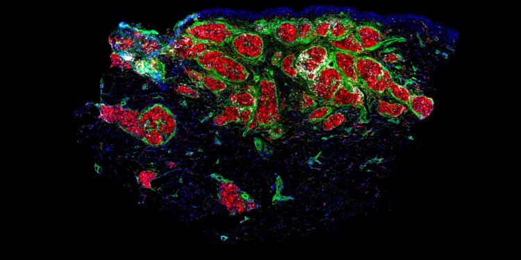 New therapeutic approach for the treatment of sarcoidosis