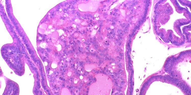 Research explains why a low-protein diet during pregnancy increases the risk of prostate cancer in offspring