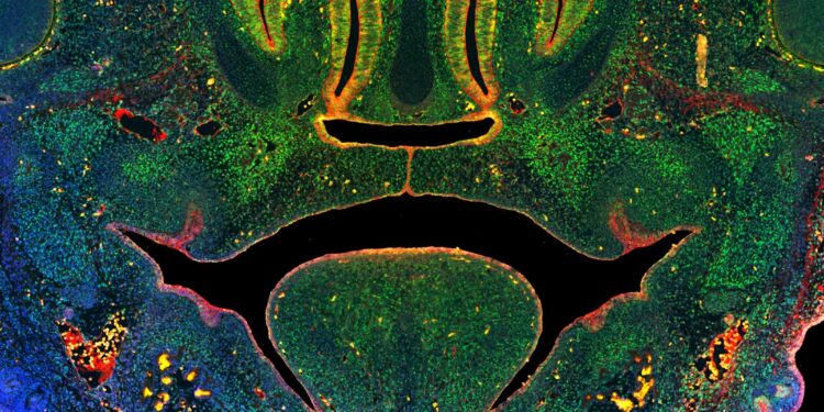 Researchers discover new clues to the cause of craniofacial birth defects