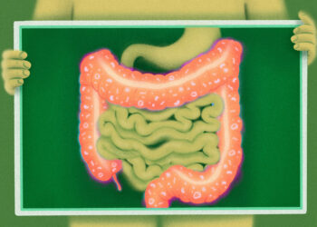 Researchers identify why cancer immunotherapy may cause colitis