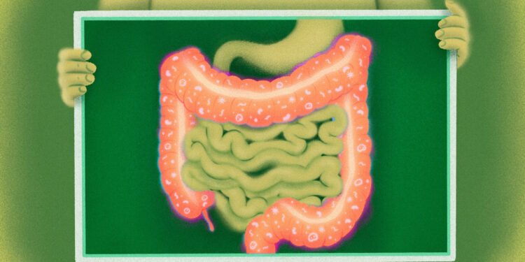 Researchers identify why cancer immunotherapy may cause colitis