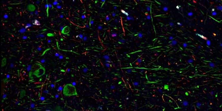 SARS-CoV-2 can infect dopamine neurons causing senescence