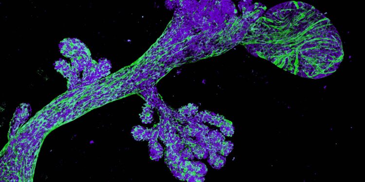 Study identifies ‘cells of origin’ of breast cancer in high-risk women