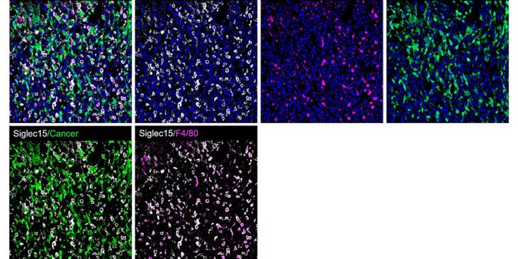 Study opens new immunological pathway to treat bone metastases from breast cancer