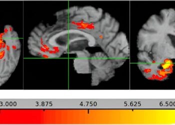 Thinning of the brain region may signal dementia risk 5 to 10 years before symptoms