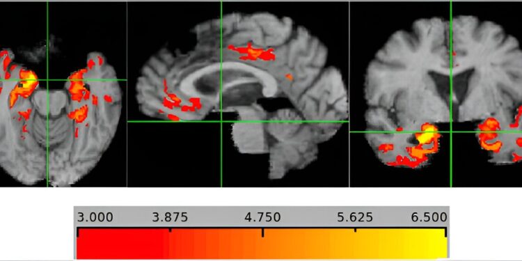 Thinning of the brain region may signal dementia risk 5 to 10 years before symptoms