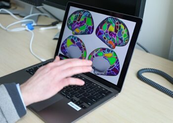 Using neuroimaging, researchers confirm cumulative brain-wide effects of ADHD