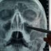 a foul odor reveals a bullet stuck in his nose for eight years
