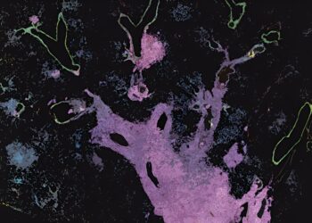 How one type of lung cancer can turn into another