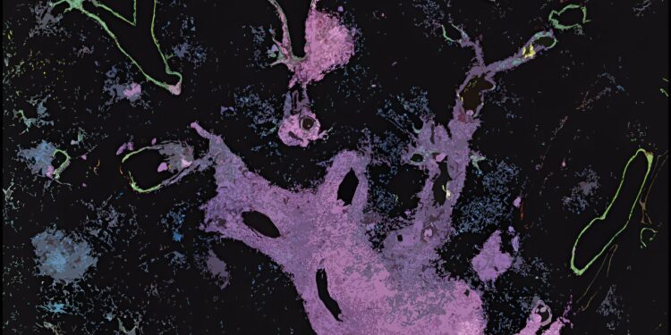 How one type of lung cancer can turn into another