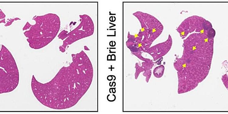 Liver metastases, metabolism and therapeutic conundrum