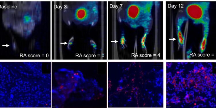 New PET tracer detects inflammatory arthritis before symptoms appear