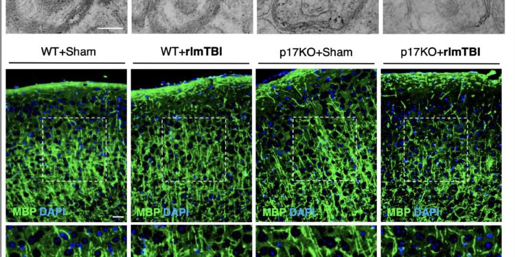 New drug could protect brain from damage caused by repeated concussions