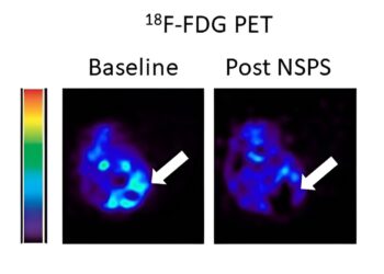 New nanomedicine targeting hydroxyapatite could be a paradigm shift for cancer treatment