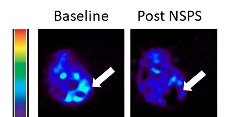 New nanomedicine targeting hydroxyapatite could be a paradigm shift for cancer treatment