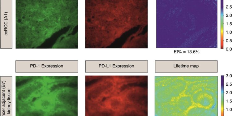 New spatial tumor mapping tool to assess cancer aggressiveness and personalize treatment