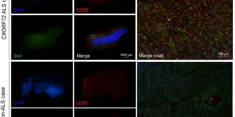 New study identifies gene suspected of causing ALS and dementia