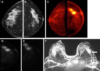 New technique has potential to transform breast cancer detection