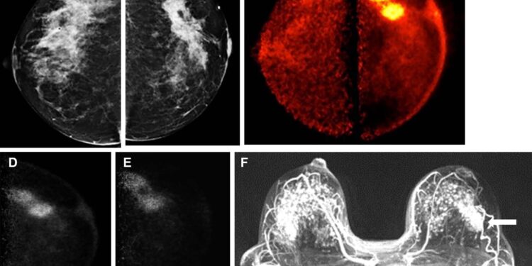 New technique has potential to transform breast cancer detection