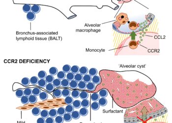 Newly Discovered Genetic Malfunction Causes Rare Lung Disease