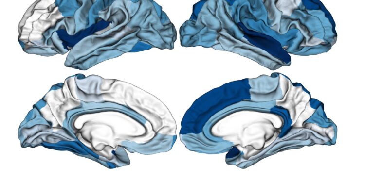 Researchers create machine learning-based classifier that could aid early diagnosis of psychosis