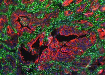 Researchers identify protein linked to metastasis in pancreatic cancer