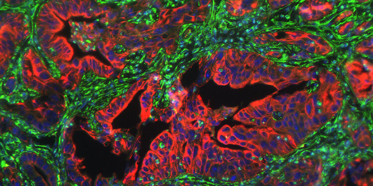 Researchers identify protein linked to metastasis in pancreatic cancer