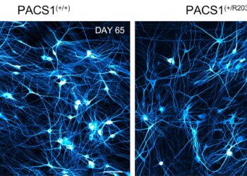 Study identifies molecular mechanisms of rare neurodevelopmental disorder