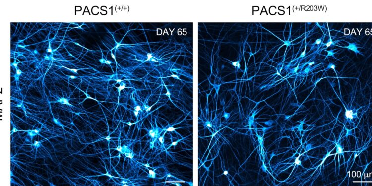 Study identifies molecular mechanisms of rare neurodevelopmental disorder