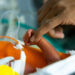 Study shows value of donated breast milk for extremely premature infants