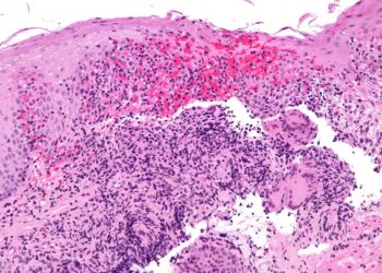 Treating newly diagnosed Crohn’s disease patients with advanced therapy leads to dramatic improvements in outcomes