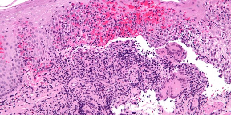 Treating newly diagnosed Crohn’s disease patients with advanced therapy leads to dramatic improvements in outcomes