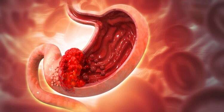 Discovery of a bacteria involved in stomach cancer