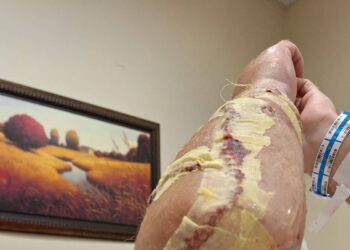 Attacked by an alligator, he almost lost his arm